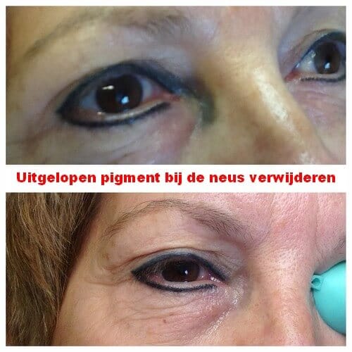 Het uitgelopen pigment bij de neus verwijderen Het uitgelopen pigment bij de neus verwijderen